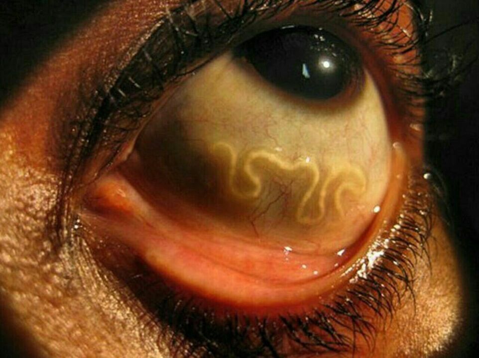 paraziti u ljudskom oku