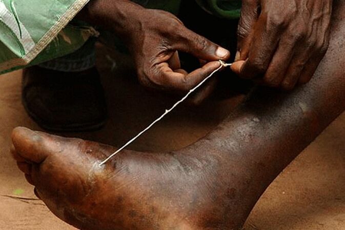 potkožni crv parazit guinea worm