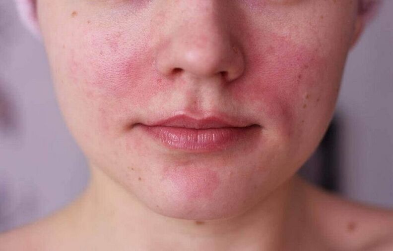 problemi s kožom kao znak prisutnosti parazita u tijelu